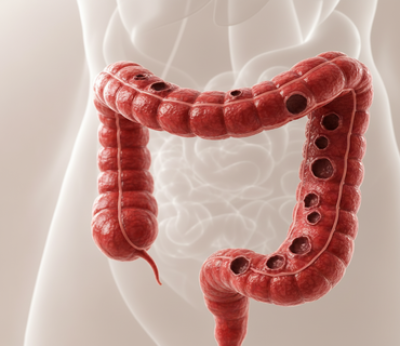 Doenças Inflamatórias Intestinais